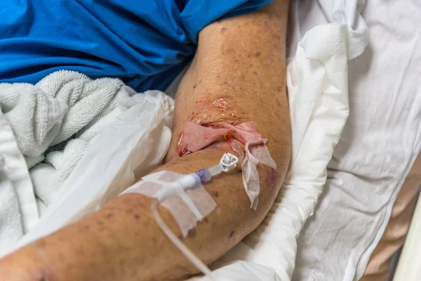 Пациент в больнице с физраствором внутривенно — стоковое фото