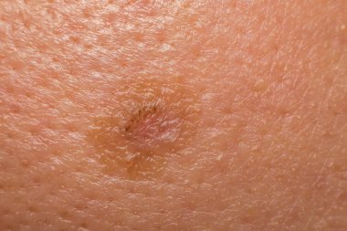 Kuru Cilt Asya insan Dermatoloji ile makro