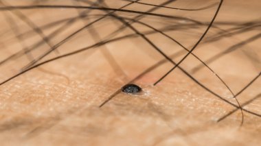 Makro siyah kıllı Asya insan kuru cilt