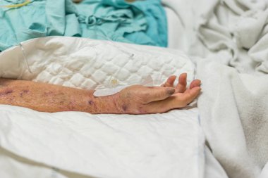 İntravenöz serum fizyolojik ile hastanede hasta