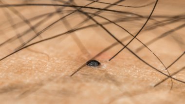 Makro siyah kıllı Asya insan kuru cilt