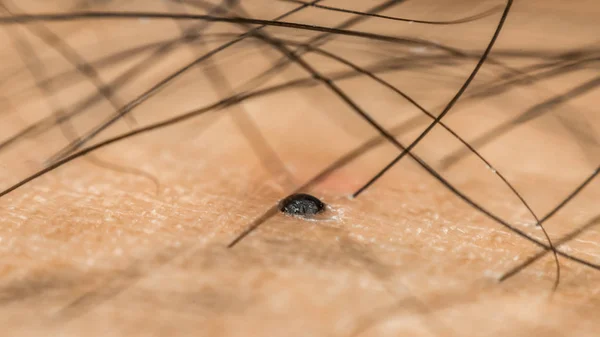 Macro de piel seca asiático humano con negro peludo — Foto de Stock