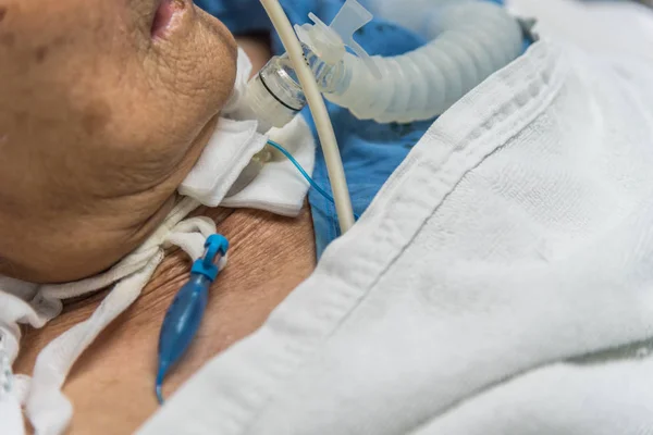 Paciente faz traqueostomia e ventilador no hospital — Fotografia de Stock