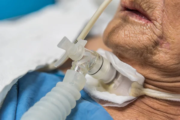 Paciente hace traqueostomía y ventilador en el hospital — Foto de Stock