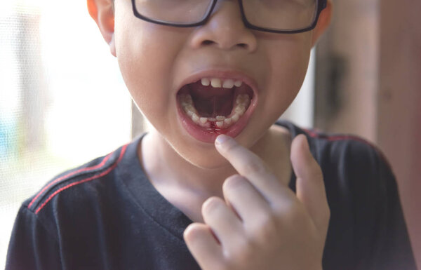 yound asian boy loosing milk tooth