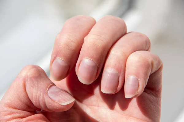 Sluit Nagels Van Vrouw Slechte Manicure Nagelriemen Overwoekerde Nagels Beschadigde — Stockfoto