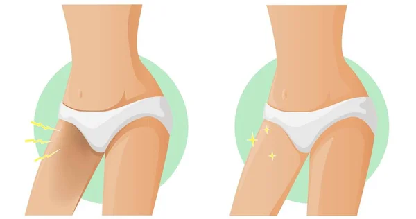 Cellulitis Vrouwen Voor Vectorillustratie — Stockvector