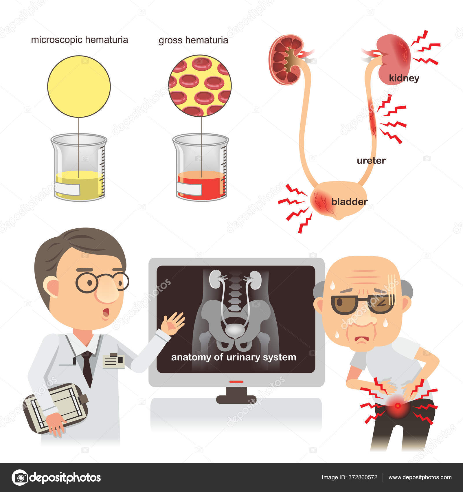 prostatite avec hematurie