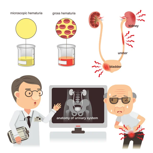 Hematuri Medicinsk Vektor Illustration — Stock vektor