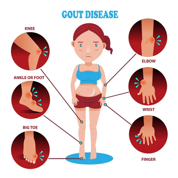 Gout Symptoms Vector Illustration — Stock Vector