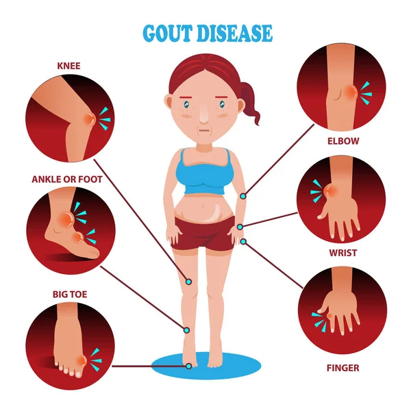 Sintomi Della Gotta Illustrazione Vettoriale — Vettoriale Stock