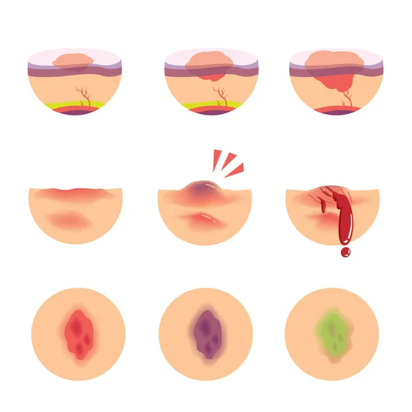 Hematomas Conjunto Ilustração Vetorial —  Vetores de Stock