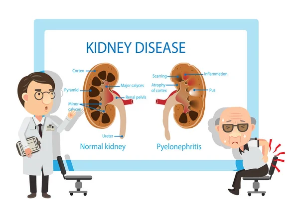 Pyelonephritis Set Vector Illustration — Stock Vector