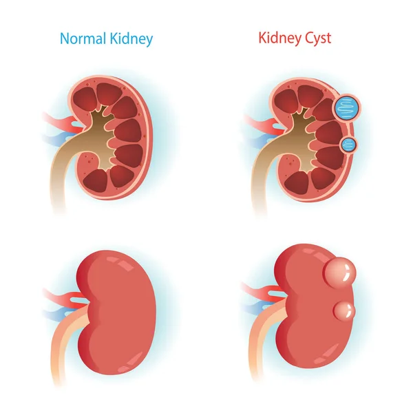 Kidney Cyst Vector Illustration — Stock Vector