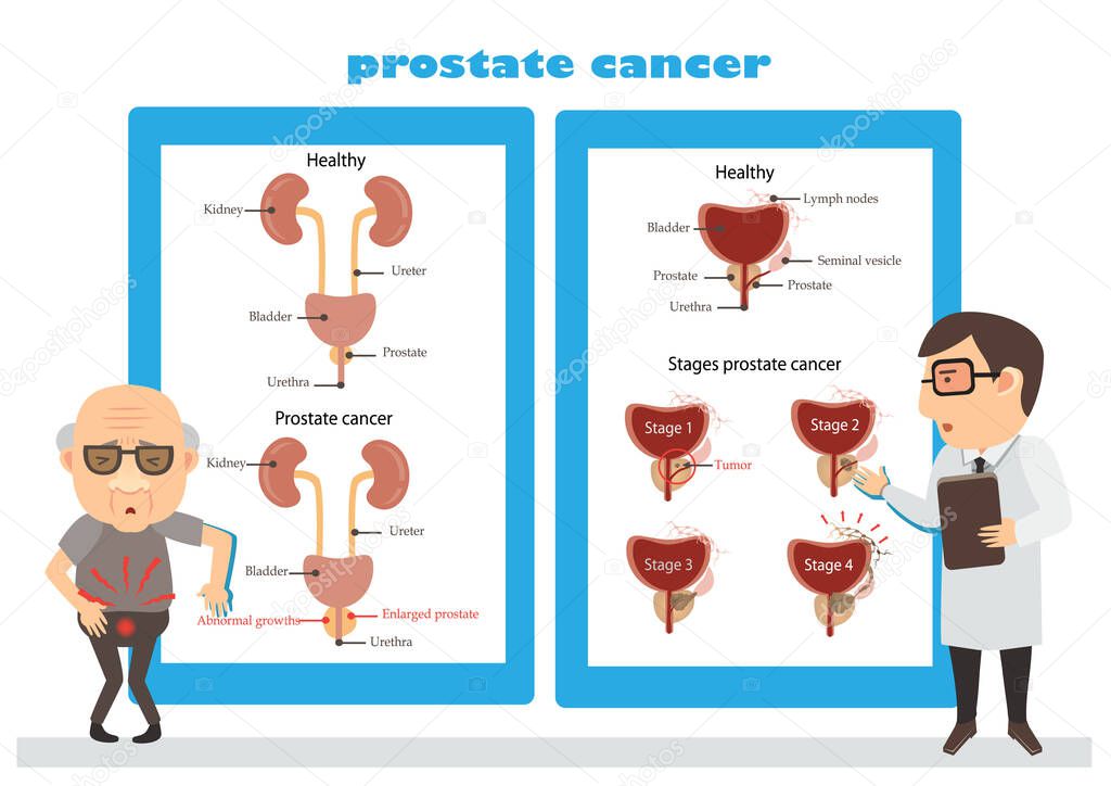 Prostate Cancer vector illustration