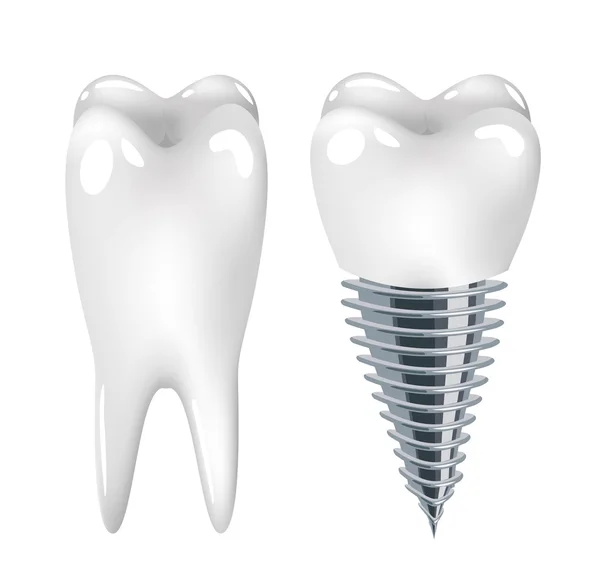 Implantes dentários odontológicos — Vetor de Stock