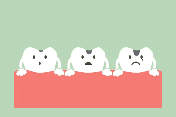 Etapas de caries dental — Archivo Imágenes Vectoriales