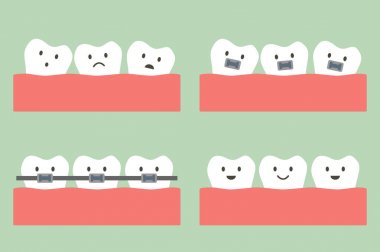 Diş Ortodonti tedavisi diş diş teli ile