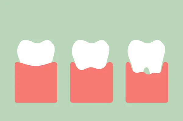 Schritt der Zahnfleischerkrankung — Stockvektor