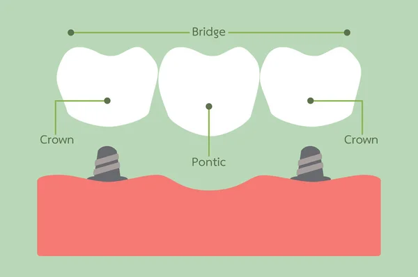 Diente - puente dental — Archivo Imágenes Vectoriales