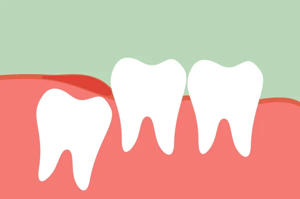 Dental - muela del juicio — Archivo Imágenes Vectoriales