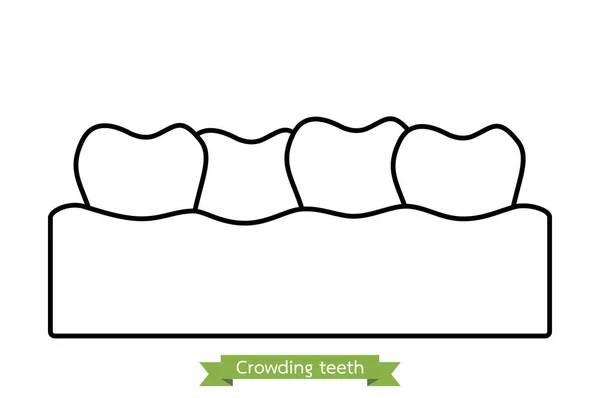 Apinhamento dos dentes (má oclusão) - desenho animado estilo contorno vetor —  Vetores de Stock