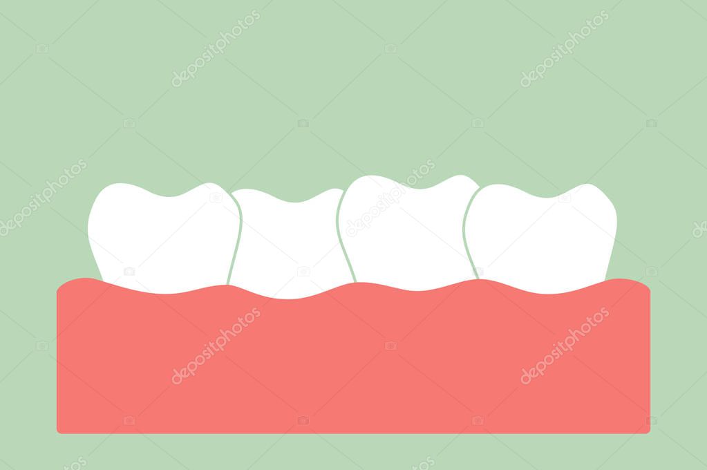 crowding teeth ( malocclusion )
