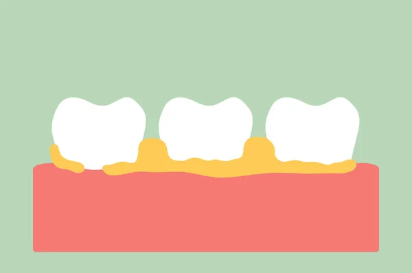 Doença periodontal com placa dental ou tártaro —  Vetores de Stock