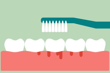 brushing teeth with bleeding on gum and tooth concept gingivitis or scurvy clipart