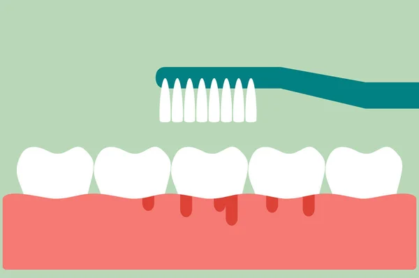 Brushing teeth with bleeding on gum and tooth concept gingivitis or scurvy — Stock Vector