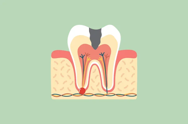 Carie struttura anatomica dei denti tra cui l'osso e gomma — Vettoriale Stock