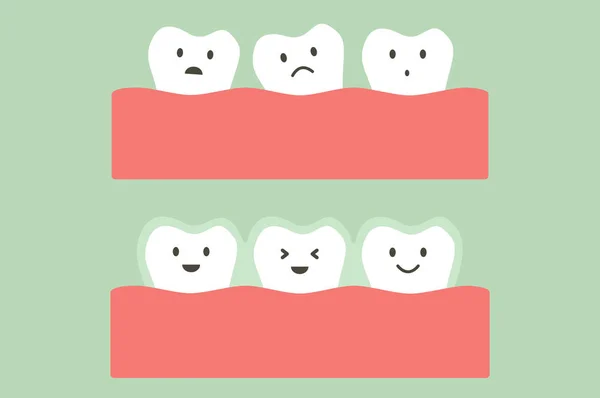 Antes y después de que los dientes usen un entrenador de silicona o aparatos ortopédicos invisibles — Archivo Imágenes Vectoriales