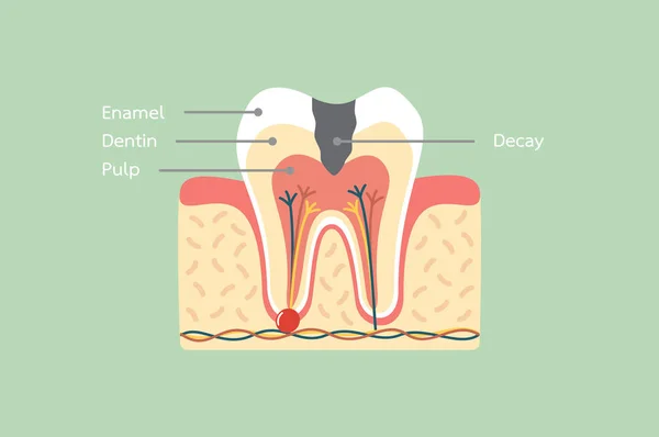 Caries estructura de la anatomía del diente incluyendo el hueso y la encía con palabra detalle — Vector de stock