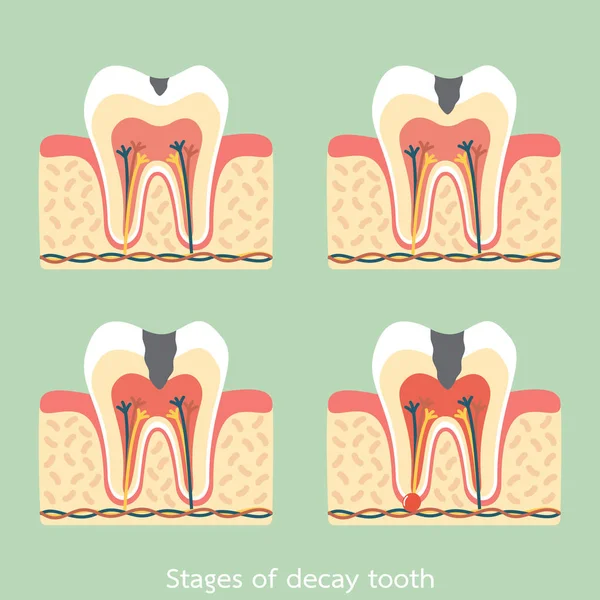 Estágios de decaimento estrutura da anatomia dentária, incluindo o osso e goma — Vetor de Stock