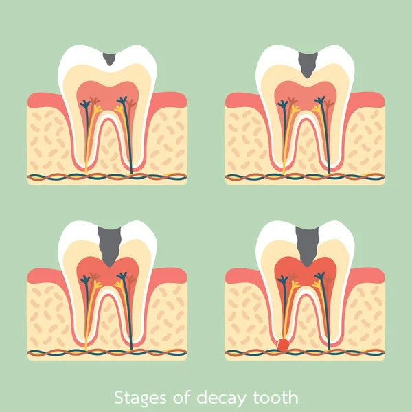 Fasi della struttura anatomica della carie, comprese le ossa e le gengive — Vettoriale Stock