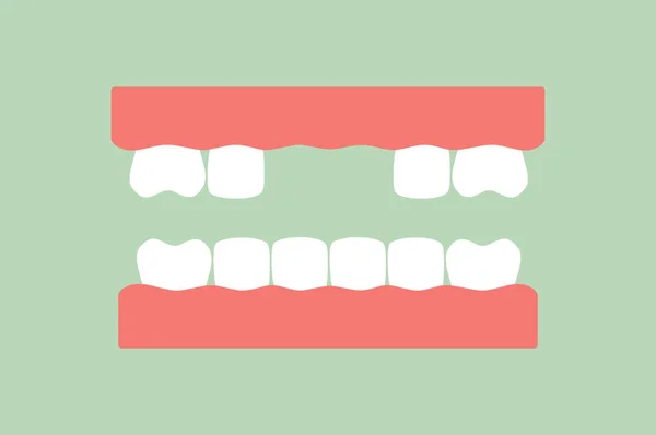 Brakujący ząb - model protezy — Wektor stockowy