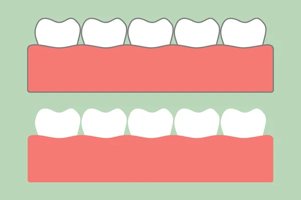 치과 치료에 대 한 껌에 건강 한 치아 — 스톡 벡터