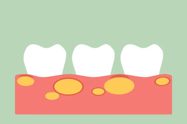 Dentes não saudáveis porque gengivite com abscesso na gengiva e placa dental ou tártaro —  Vetores de Stock