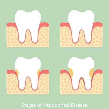 Adım periodontal hastalık / / periodontitis / dişeti iltihabı / dişeti hastalığı, diş sorunu