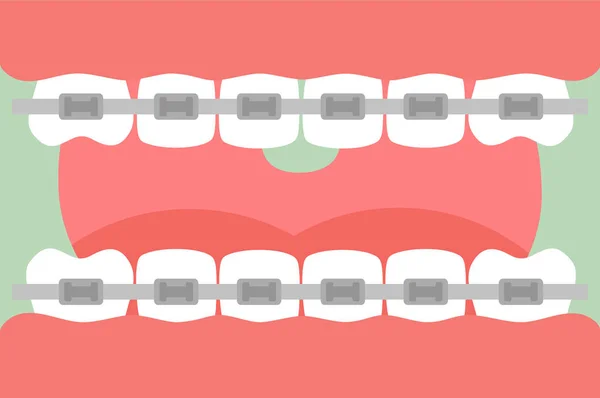 Fogszabályozás fogak és fogászati nadrágtartó, nyitott szájjal, az egészséges fogak és a nyelv — Stock Vector