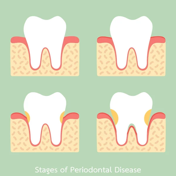 Βήμα της περιοδοντικής νόσου / περιοδοντίτιδας / ουλίτιδας / περιοδοντική νόσος, οδοντιατρική πρόβλημα — Διανυσματικό Αρχείο