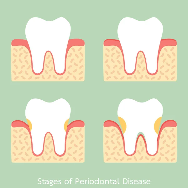 Paso de la enfermedad periodontal / periodontitis / gingivitis / enfermedad de las encías, problema dental — Archivo Imágenes Vectoriales