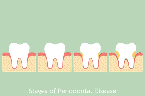Lépés a fogágybetegség / fogágy / ínygyulladás / ínybetegségek, fogászati probléma — Stock Vector