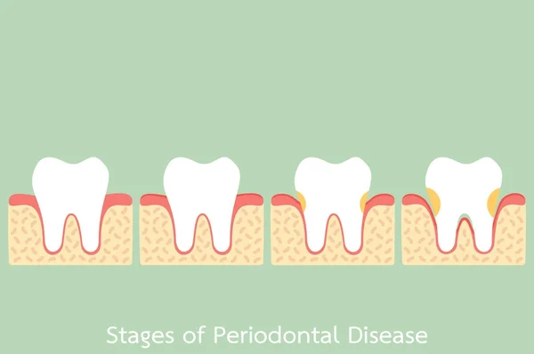 Etapa da doença periodontal / periodontite / gengivite / doença gengival, problema dentário —  Vetores de Stock