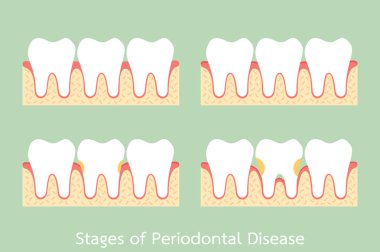 Adım periodontal hastalık / / periodontitis / dişeti iltihabı / dişeti hastalığı, diş sorunu