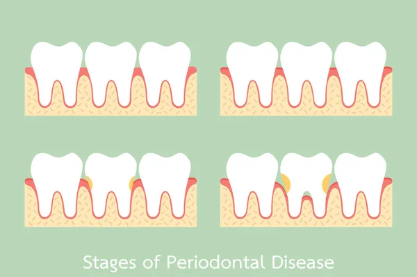 Steg av tandlossning / parodontit / gingivit / tandköttsproblem, tand problem — Stock vektor