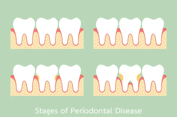 Schritt der Parodontitis / Parodontitis / Gingivitis / Zahnfleischerkrankung, Zahnprobleme — Stockvektor