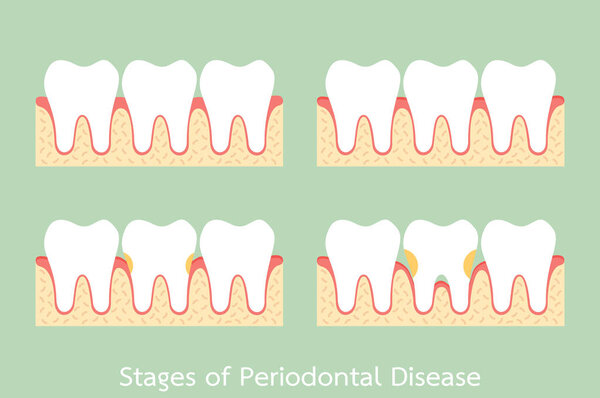 step of periodontal disease / periodontitis / gingivitis / gum disease, dental problem