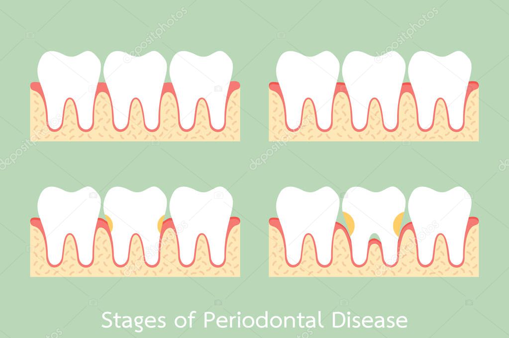 step of periodontal disease / periodontitis / gingivitis / gum disease, dental problem