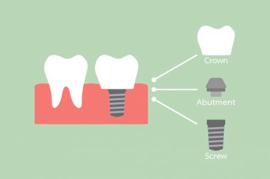 structure of the dental implant with all parts disassembled, crown, abutment, screw clipart